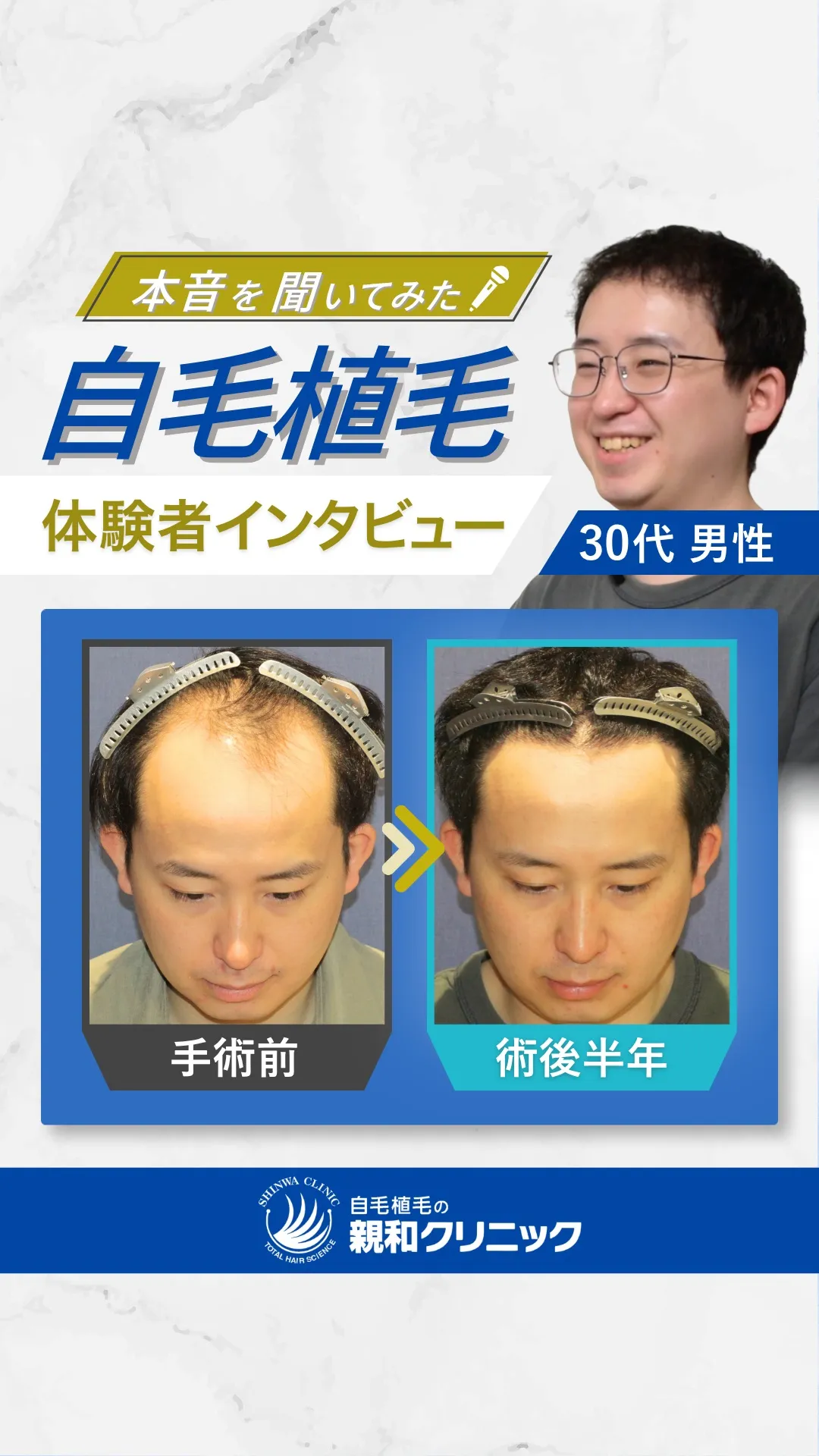 自毛植毛体験者インタビュー 30代男性