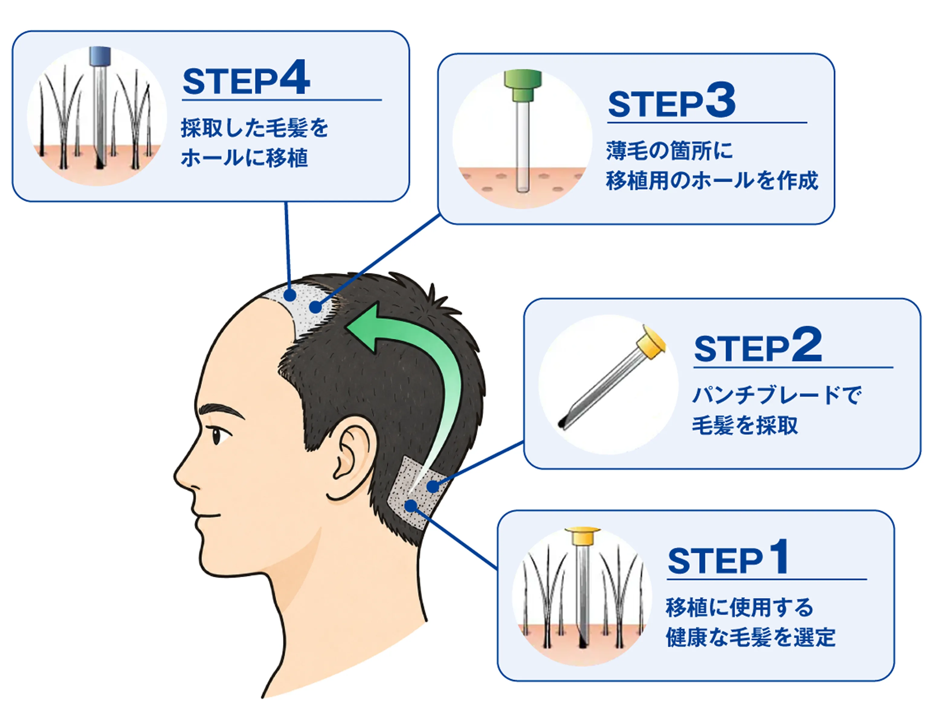自毛植毛の流れ